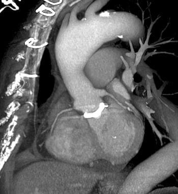 心脏CT（人工心脏瓣膜的3D扫描）