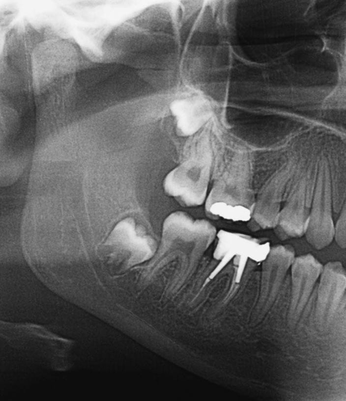 m7820249_impacted_wisdom_teeth_x-ray_science_photo_library_high_zh