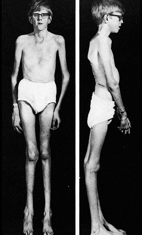 marfan_syndrome_a_high_zh