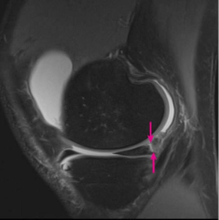 MRI_knee_meniscocapsular_separation_arrow_high_zh