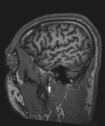 正常脑MRI（矢状）–