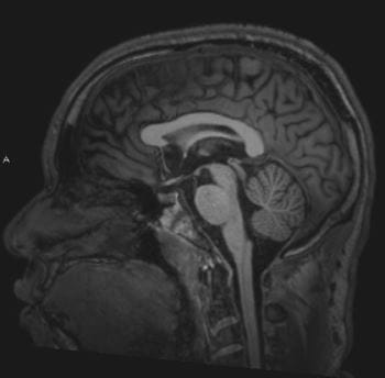 正常脑MRI（矢状）