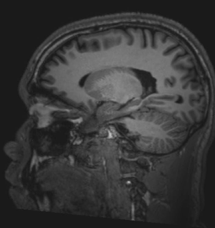 Image Normal Brain Mri Sagittal Slide 5 Msd诊疗手册专业版