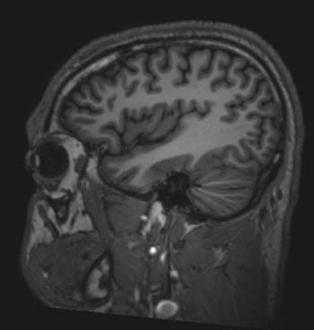 正常脑MRI（矢状）