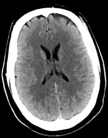 正常头部CT扫描(成人，30岁)-第4张