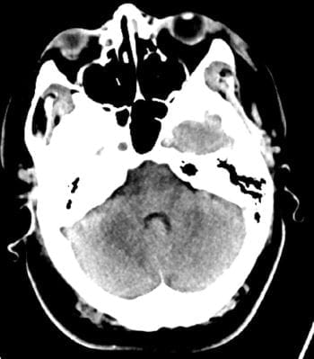 正常头部CT扫描(成人，30岁)-第7张