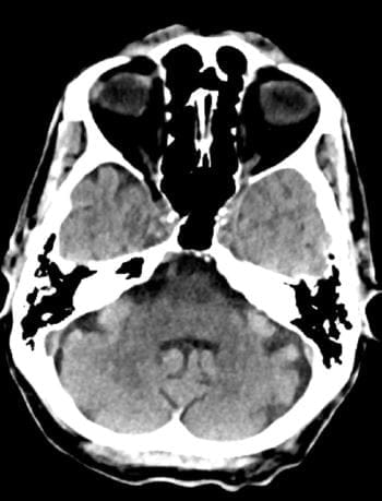 正常头部CT扫描（成人，74岁）-第8张
