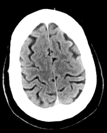 正常头部CT扫描(成人，30岁)-第1张