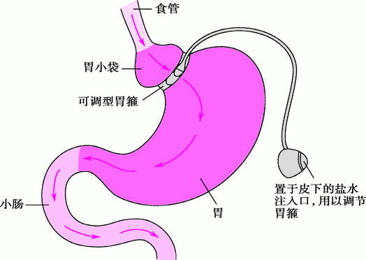 可调型胃束带手术