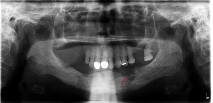 osteomyelitis-pano-benson-dental-emergencies-arrow-pv-high_zh