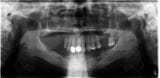 拔牙后牙槽炎（干槽症）