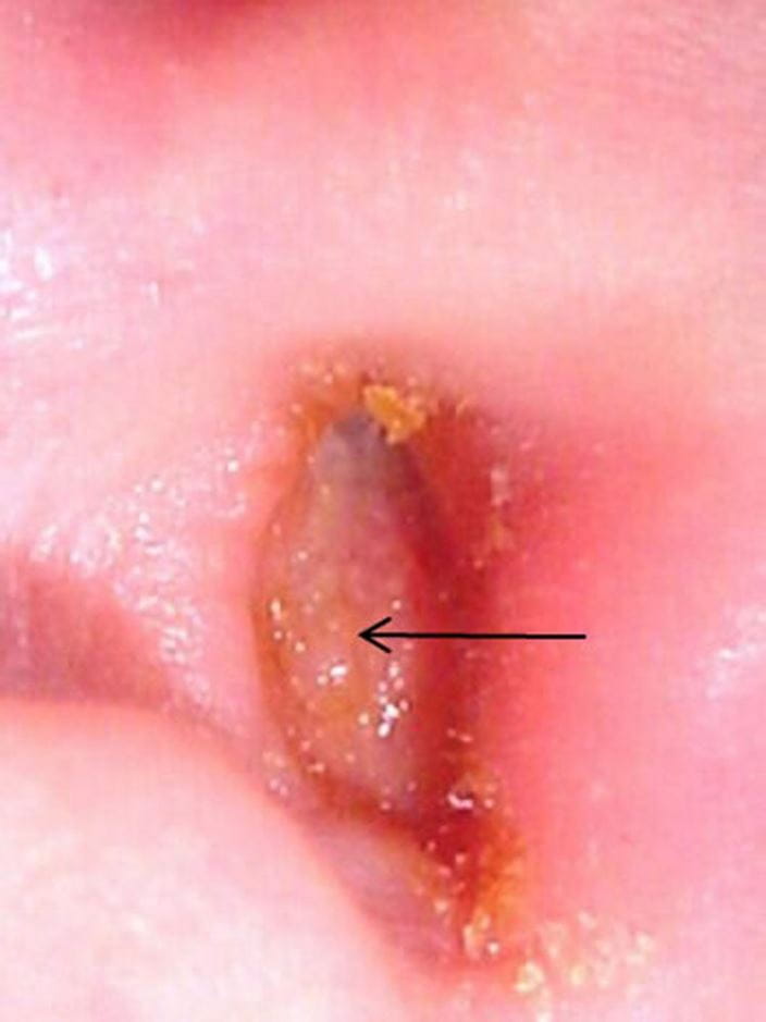 otitis_externa_with_furuncle_high_arrow_zh