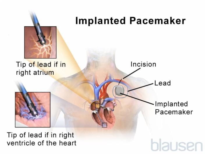 pacemaker_placement_high_blausen_zh