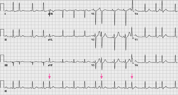 PACs-premature-atrial-contractions-arrows-high_zh