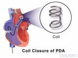 动脉导管未闭（PDA）