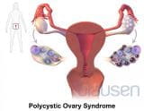多囊卵巢综合征(PCOS)