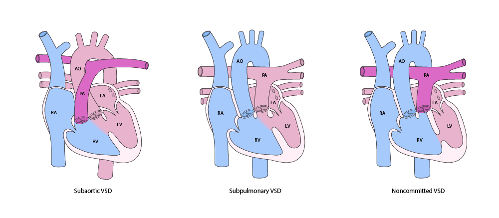 右心室双出口 (DORV) 的主要变异