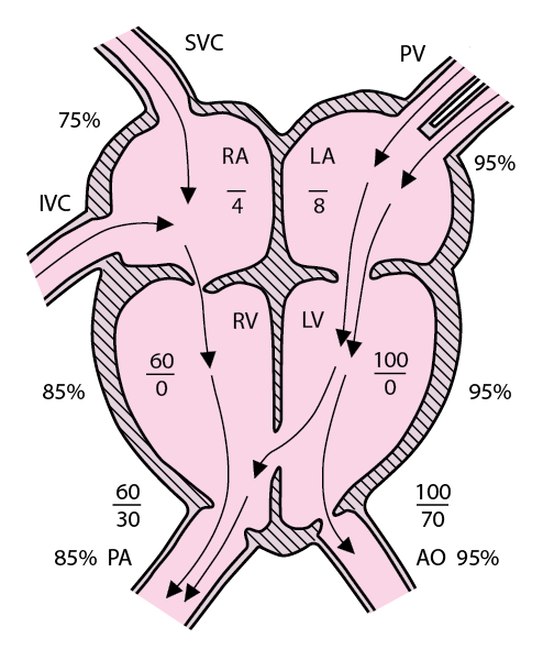 PED_ventricular_septal_defect_zh