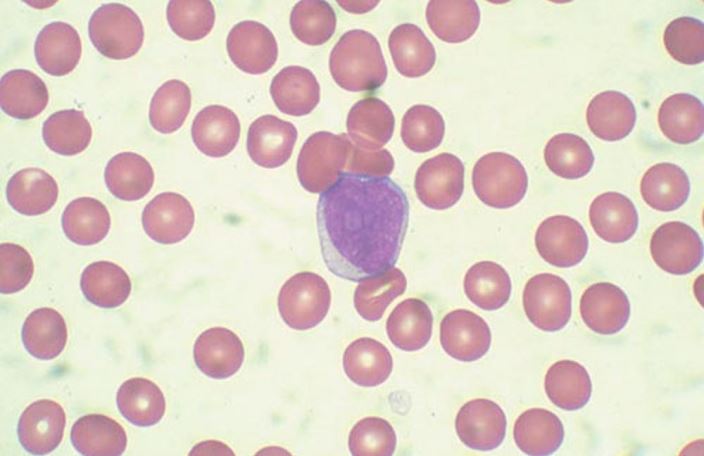 Peripheral_blood_blast_cell_high_zh