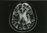 进行性多灶性白质脑病 (PML)