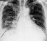 急性低氧性呼吸衰竭 (AHRF, ARDS)