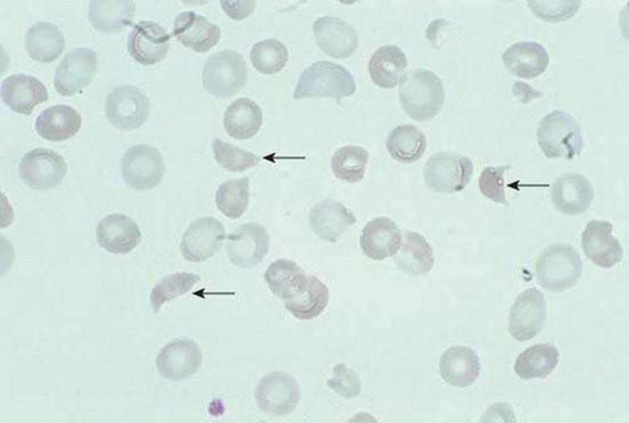 schistocytes-arrow-removed-high_zh
