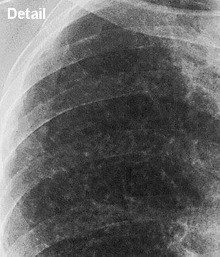 silicosis_simple_upper_lung_high_zh