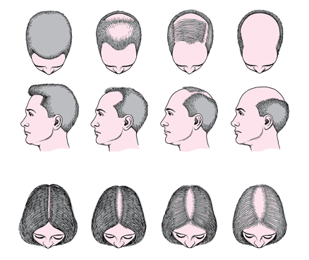 男性和女性型脱发（雄激素性脱发）