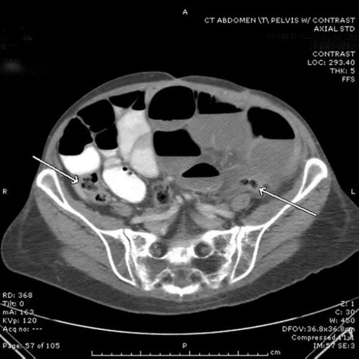 small-bowel-obstruction-CT-ansari-sized_zh