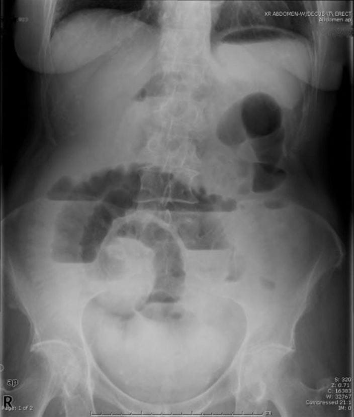 small-bowel-obstruction-upright-ansari-sized_zh