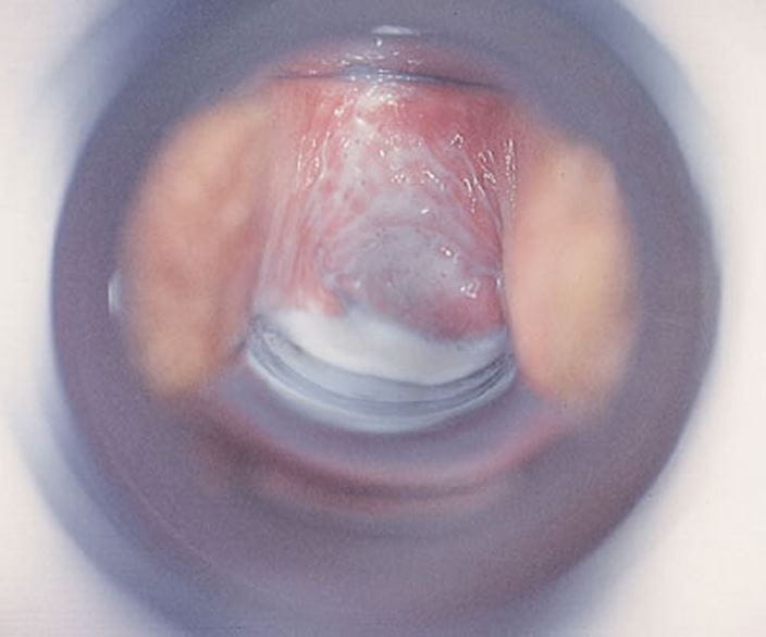 speculum_exam_bacterial_vaginosis_high_zh