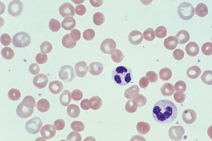 spherocytes_hemolytic_anemia_high_zh