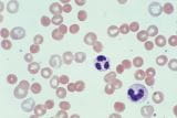 遗传性球形红细胞增多症和遗传性椭圆形红细胞增多症