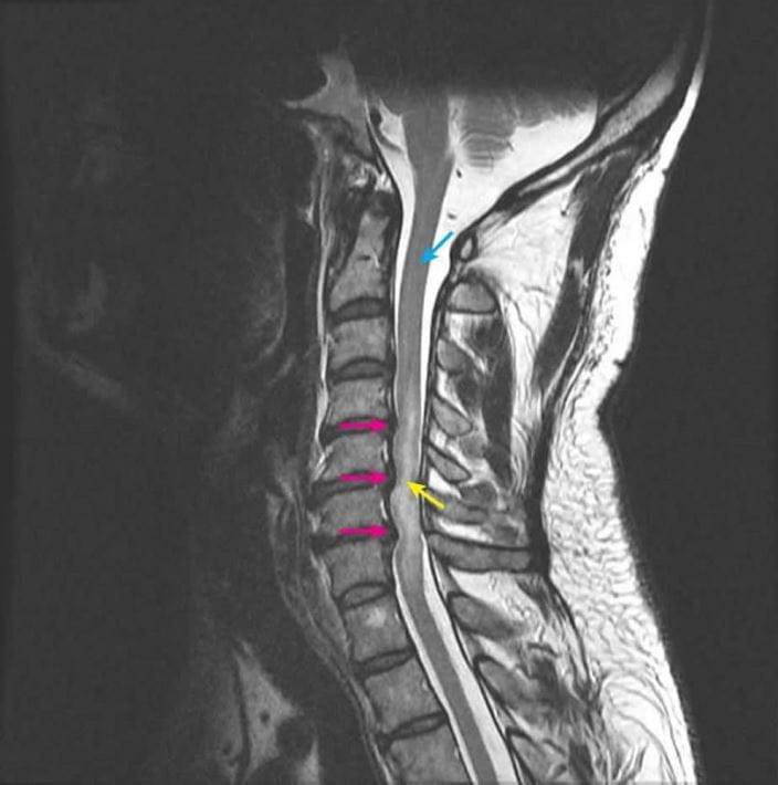 spinal_cord_compression_slide_high_zh