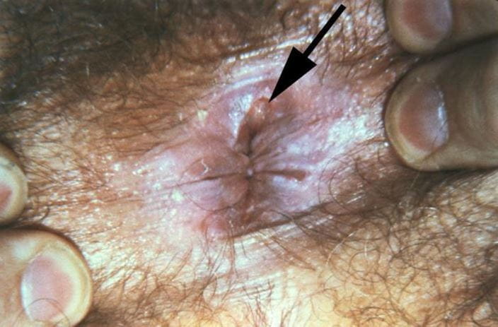 syphilis_primary_anal_orig_high_zh