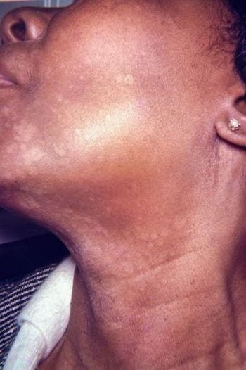 面部和颈部出现色素减退斑疹和斑块的花斑癣