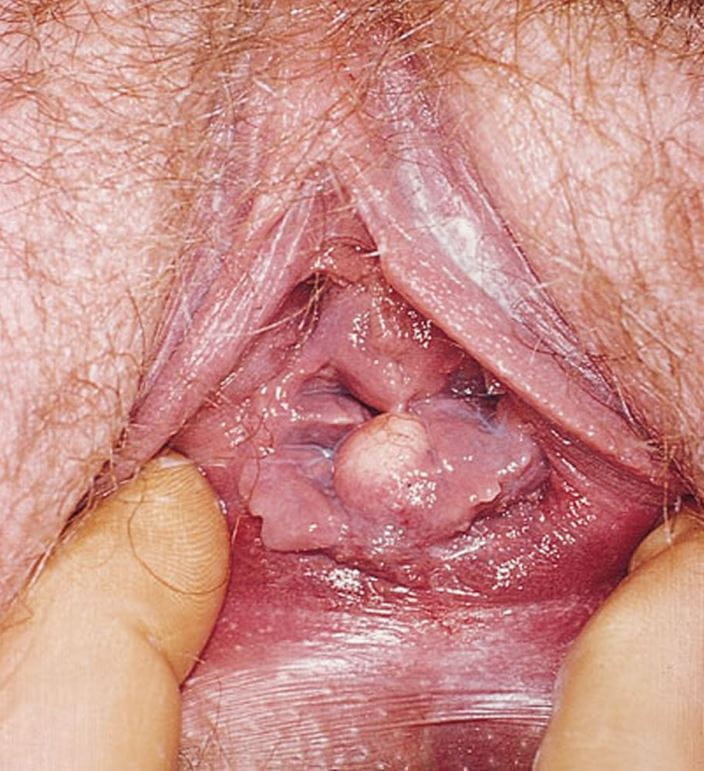 vaginal_inclusion_cyst_high_zh